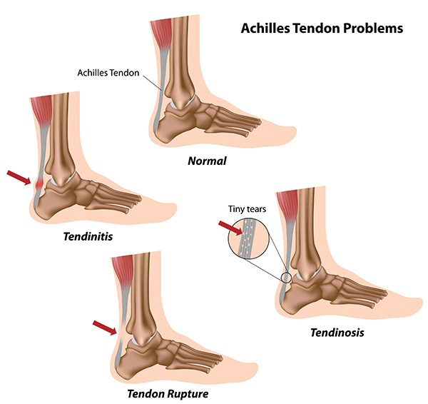 The Foot and Ankle Center of Kirkland | Foot Surgery, Fungal Nails and Diabetic Foot Care