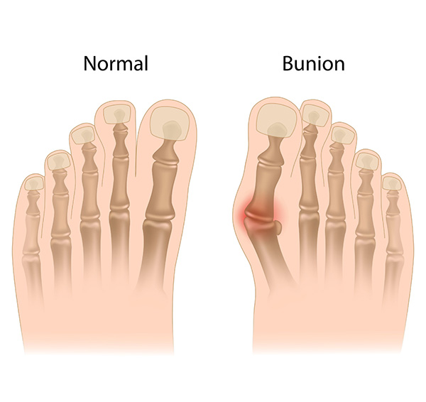 The Foot and Ankle Center of Kirkland | Diabetic Foot Care, Plantar Fasciitis and Corns and Calluses